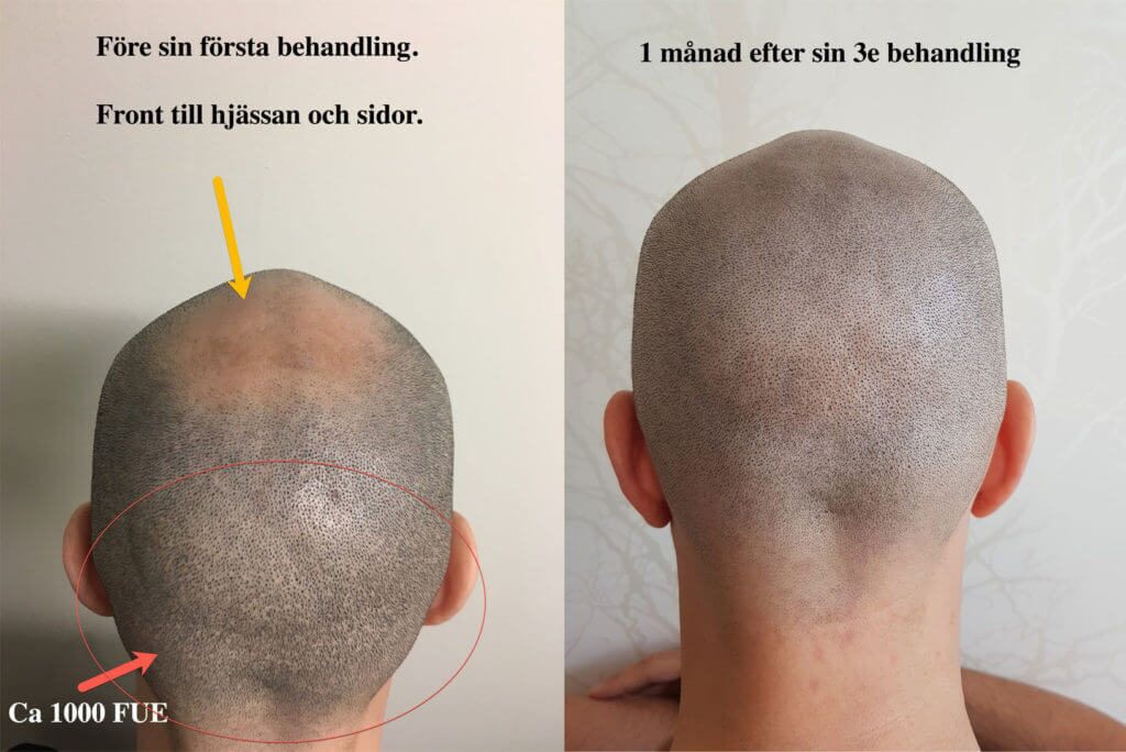 scalp-micropigmentation-Fue-ärr-scalp-micropigmentation