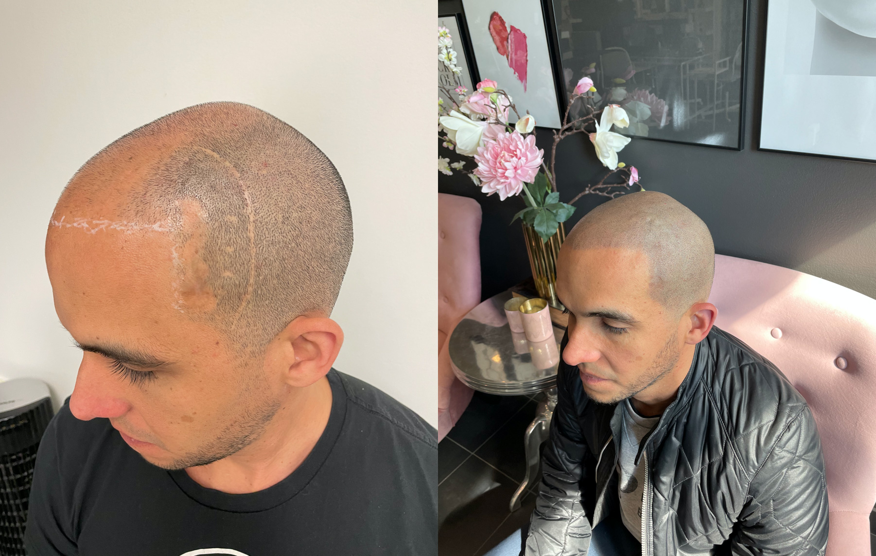 Scalp Micropigmentation - Före & efter scalp micropigmentation - Before & after scalp micropigmentation - 1